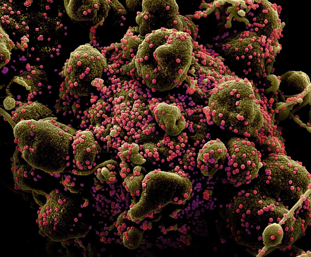 Colorized scanning electron micrograph of an apoptotic cell (greenish brown) heavily infected with SARS-COV-2 virus particles (pink), also known as novel coronavirus, isolated from a patient sample. Image captured and color-enhanced at the NIAID Integrated Research Facility (IRF) in Fort Detrick, Maryland. National Institute of Allergy and Infectious Diseases, NIH/Handout via REUTERS. THIS IMAGE HAS BEEN SUPPLIED BY A THIRD PARTY. MANDATORY CREDIT - RC29RF9MI508