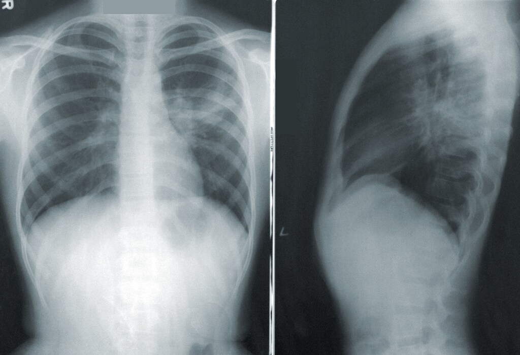 Radiografía mostrando neumonía.