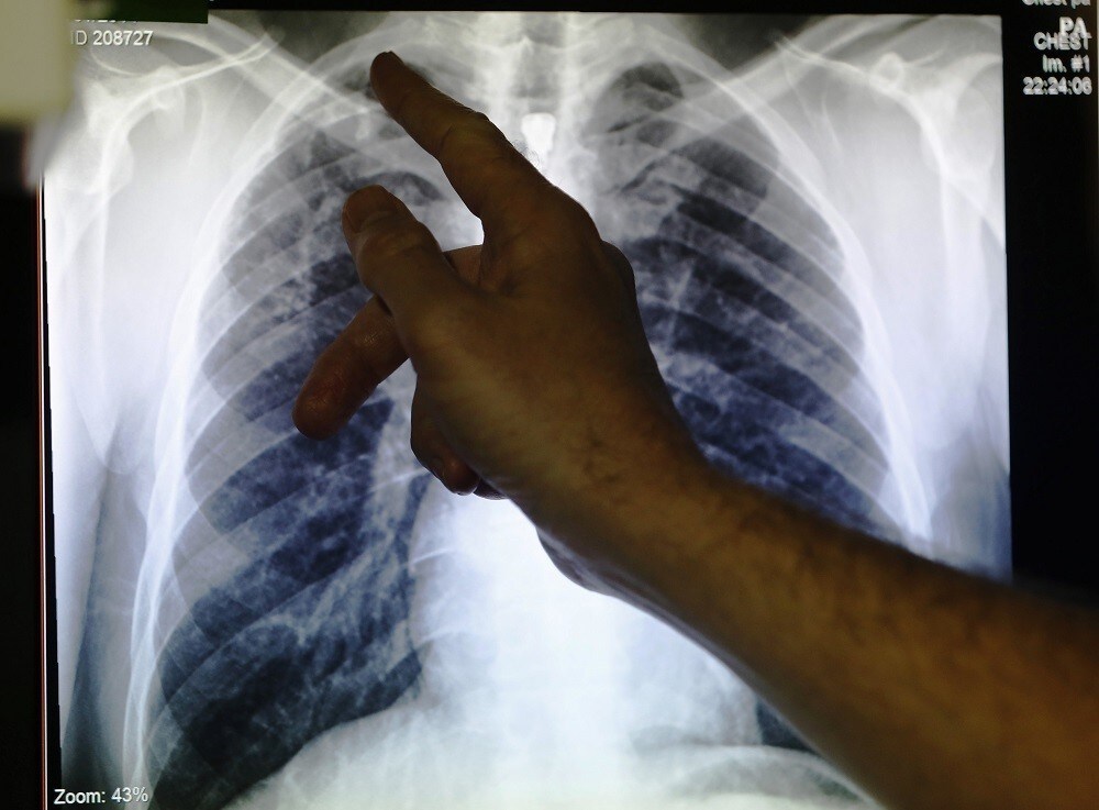 Clinical lead Doctor Al Story points to an x-ray showing a pair of lungs infected with TB (tuberculosis) during an interview with Reuters on board the mobile X-ray unit screening for TB in Ladbroke Grove in London January 27, 2014. The only mobile unit testing for TB in the country works with the most vulnerable to the disease including the homeless, drug and alcohol dependent. REUTERS/Luke MacGregor (BRITAIN - Tags: HEALTH SOCIETY) - RTX17X9Q