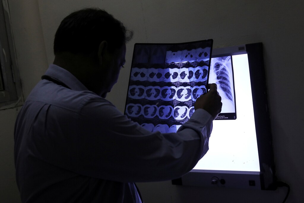 Dr. Desh Deepak, a senior chest physician, checks the CT scan of lungs of a patient at Ram Manohar Lohia hospital in New Delhi, India, November 5, 2018. Picture taken November 5, 2018. REUTERS/Anushree Fadnavis - RC1B7CBFA290