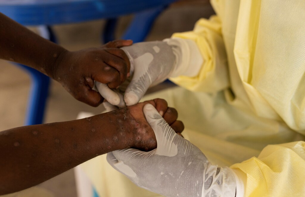 Una enfermera de laboratorio toma una muestra de un niño con un caso sospechoso de mpox, una enfermedad infecciosa causada por el virus de la viruela símica que provoca una erupción dolorosa, agrandamiento de los ganglios linfáticos y fiebre. En el centro de tratamiento de Munigi, tras casos de Mpox en el territorio de Nyiragongo cerca de Goma, provincia de Kivu del Norte, República Democrática del Congo, 19 de julio de 2024.