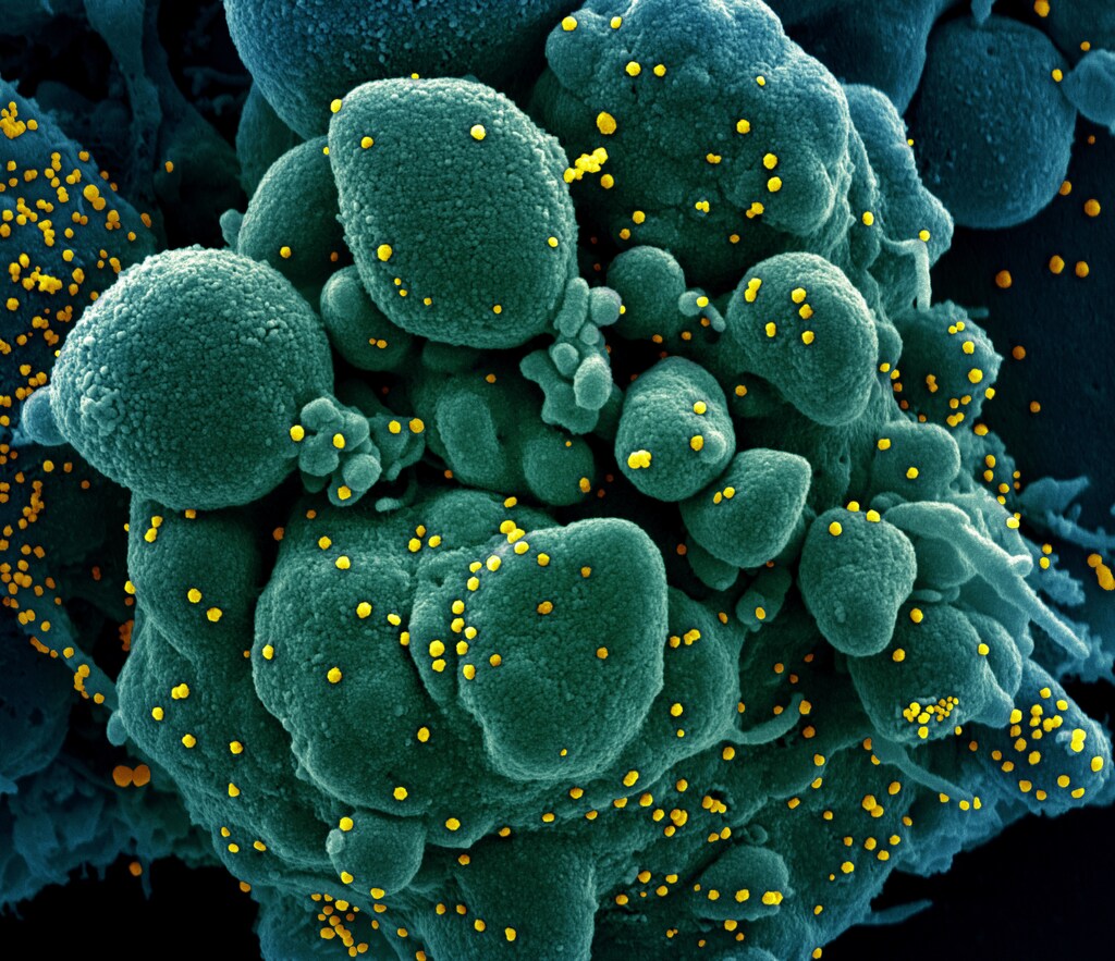 Colorized scanning electron micrograph of an apoptotic cell (green) infected with SARS-COV-2 virus particles (yellow), also known as novel coronavirus, isolated from a patient sample. Image captured at the NIAID Integrated Research Facility (IRF) in Fort Detrick, Maryland. National Institute of Allergy and Infectious Diseases, NIH/Handout via REUTERS. THIS IMAGE HAS BEEN SUPPLIED BY A THIRD PARTY. MANDATORY CREDIT - RC29RF9I0B4U