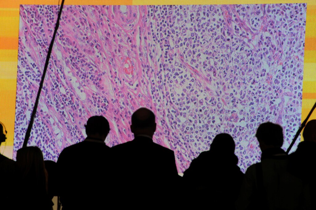 Cancer cells are seen on a large screen connected to a microscope at the CeBit computer fair in Hanover, Germany, March, 6, 2012. To match Insight HEALTH-CANCER/IMMUNOTHERAPY REUTERS/Fabian Bimmer/File Photo - D1AEUGEJENAB