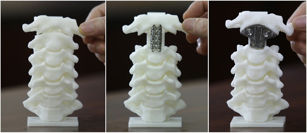 Combination picture of a spine model, a spine model implanted with a traditionally used titanium tube, and a spine model implanted with a 3D-printed artificial axis (L-R), are displayed at Peking University Third Hospital in Beijing, August 14, 2014. Chinese doctor Liu Zhongjun has successfully implanted an artificial axis produced by a 3D printer into the spine of a bone cancer patient. This was the first time that an axis produced by 3D printing had been implanted into a patient, according to Liu. Normally, a diseased axis would be replaced by a standardised, hollow titanium tube, said Liu. Pictures taken August 14, 2014. REUTERS/Jason Lee (CHINA - Tags: SCIENCE TECHNOLOGY HEALTH) - RTR43AAP