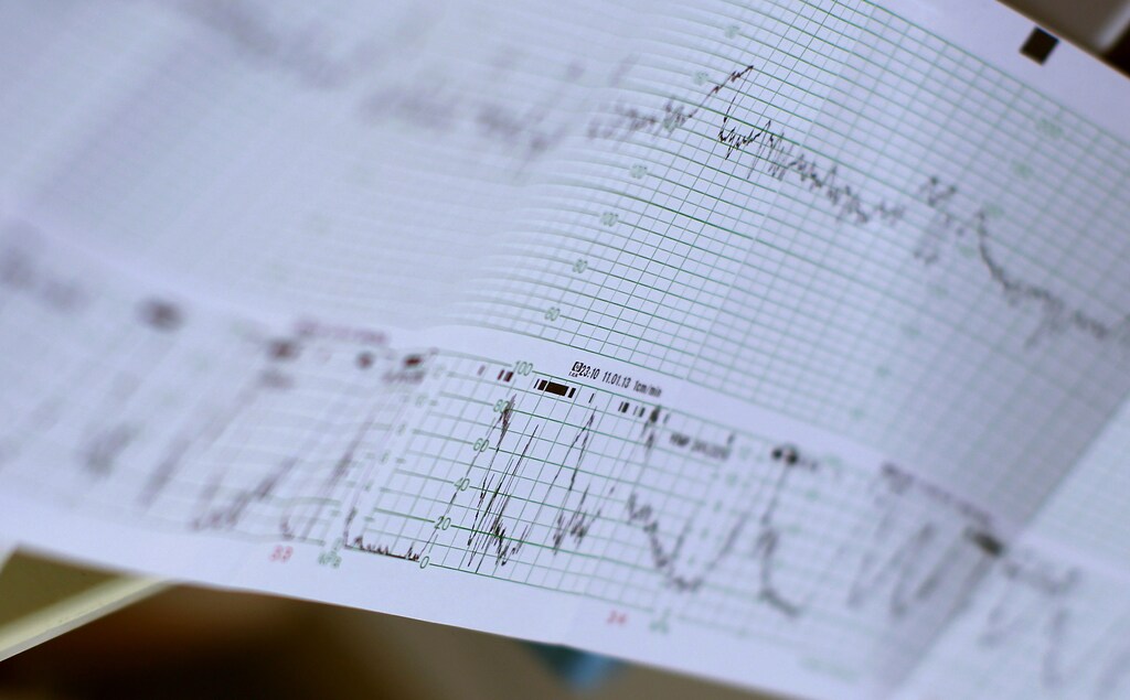 Cardiotocograph paper is pictured as pregnant Sabine Heinrich is in labour in a delivery room of hospital in Fuerstenfeldbruck, southern Germany, January 11, 2013. The birth of her second child was planned for January 12, 2013. Cardiotocography (CTG) is used during pregnancy to monitor the fetal heartbeat and the uterine contractions. REUTERS/Michaela Rehle (GERMANY - Tags: HEALTH SOCIETY) - BM2E91M1C6701
