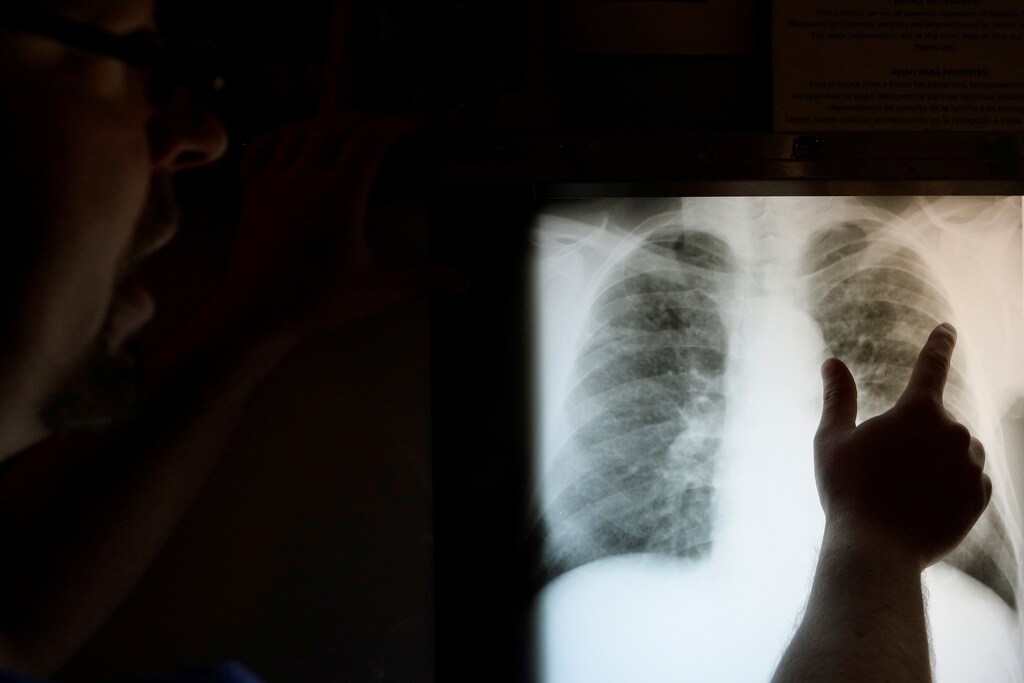 Radiological technician Mark Davis looks at the chest x-ray of retired coal miner James Marcum, who has complicated black lung disease, at the Stone Mountain Health Services in St. Charles, Virginia, U.S., May 18, 2018. According to Davis, there are no digital x-ray machines in the county, except at a veterinary clinic, so the x-ray film has to be sent to a radiologist to be read, adding weeks to the process of diagnosis. REUTERS/Brian Snyder SEARCH "BLACK LUNG" FOR THIS STORY. SEARCH "WIDER IMAGE" FOR ALL STORIES. - RC1BCD144F70