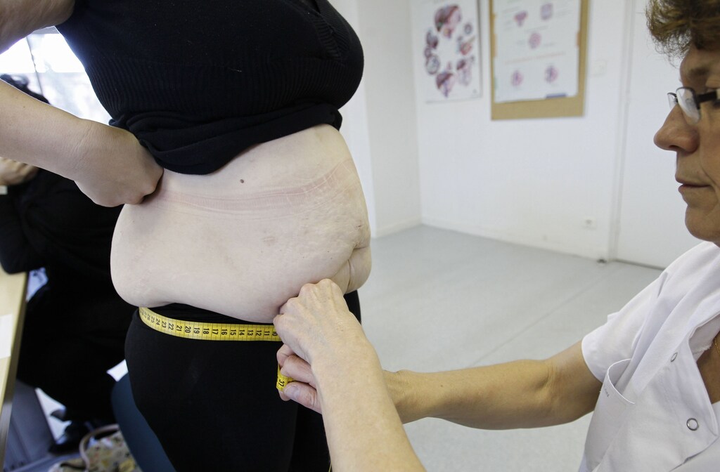 A nurse measures an obese patient at the office of surgeon Dr. Alexandre Lesage's to prepare for surgery at the Saint Jean d'Angely Hospital, in Saint Jean d'Angley, southwestern France, January 24, 2013. The patient hopes to lose some 50 kilos (110 pounds) in the next year after she undergoes surgery for obesity. Picture taken January 24, 2013. REUTERS/Regis Duvignau (FRANCE - Tags: HEALTH) - PM1E91P1BG601