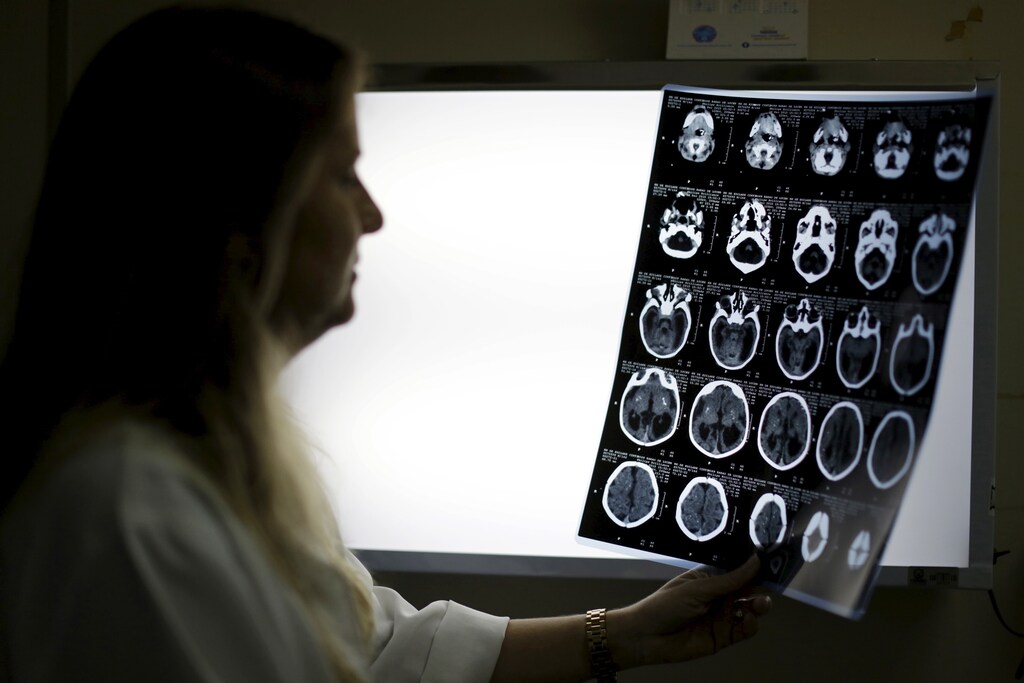 Child Neurologist Vanessa Van Der Linden observes the X-ray of a baby's skull with microcephaly at the hospital Barao de Lucena in Recife, Brazil, January 26, 2016. Health authorities in the Brazilian state at the center of a rapidly spreading Zika outbreak have been overwhelmed by the alarming surge in cases of babies born with microcephaly, a neurological disorder associated to the mosquito-borne virus. Picture taken on January 26, 2016. REUTERS/Ueslei Marcelino - RTX24A51