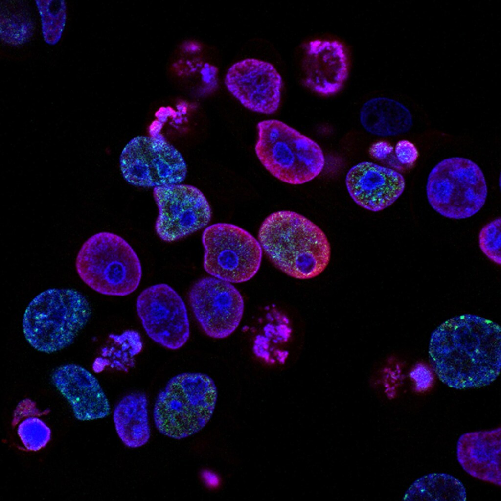Human cancer cells