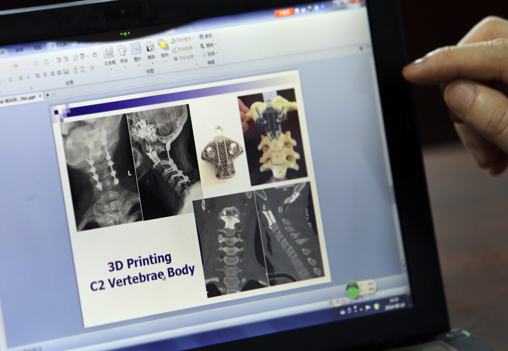Chinese doctor Liu Zhongjun gives an explanation of the 3D-printed artificial axis he has successfully implanted into the spine of a bone cancer patient at Peking University Third Hospital in Beijing, August 14, 2014. This was the first time that an axis produced by 3D printing had been implanted into a patient, according to Liu. Normally, a diseased axis would be replaced by a standardised, hollow titanium tube, said Liu. Picture taken August 14, 2014. REUTERS/Jason Lee (CHINA - Tags: SCIENCE TECHNOLOGY HEALTH) - GM1EA8M0C3R01