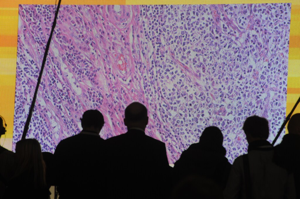 Cancer cells are seen on a large screen connected to a microscope at the CeBit computer fair in Hanover, March, 6, 2012. The biggest fair of its kind will run to March 10, 2012. REUTERS/Fabian Bimmer