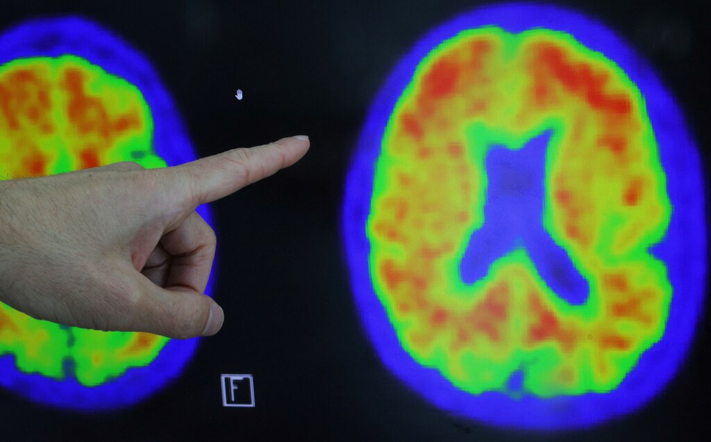 Un ensayo clínico mundial del nuevo fármaco donanemab para el Alzheimer demuestra una ralentización del deterioro cognitivo.