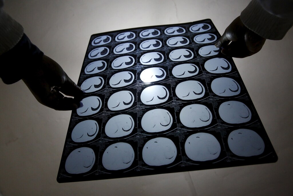 Cancer patient Cao Dongxian poses with CT scan images of his intestine at a hotel room where he stays, near the Peking Union hospital, during an interview with Reuters in Beijing, China, April 6, 2016. Picture taken April 6, 2016.