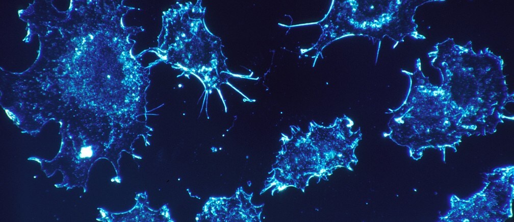 What causes cancer: bad luck or lifestyle choices?