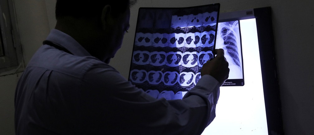 Dr. Desh Deepak, a senior chest physician, checks the CT scan of lungs of a patient at Ram Manohar Lohia hospital in New Delhi, India, November 5, 2018. Picture taken November 5, 2018. REUTERS/Anushree Fadnavis - RC1B7CBFA290