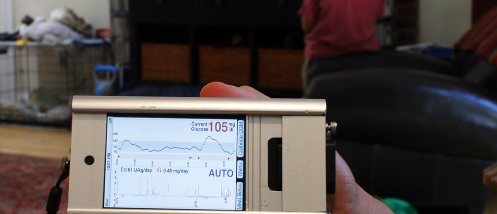The artificial pancreas helping manage diabetes