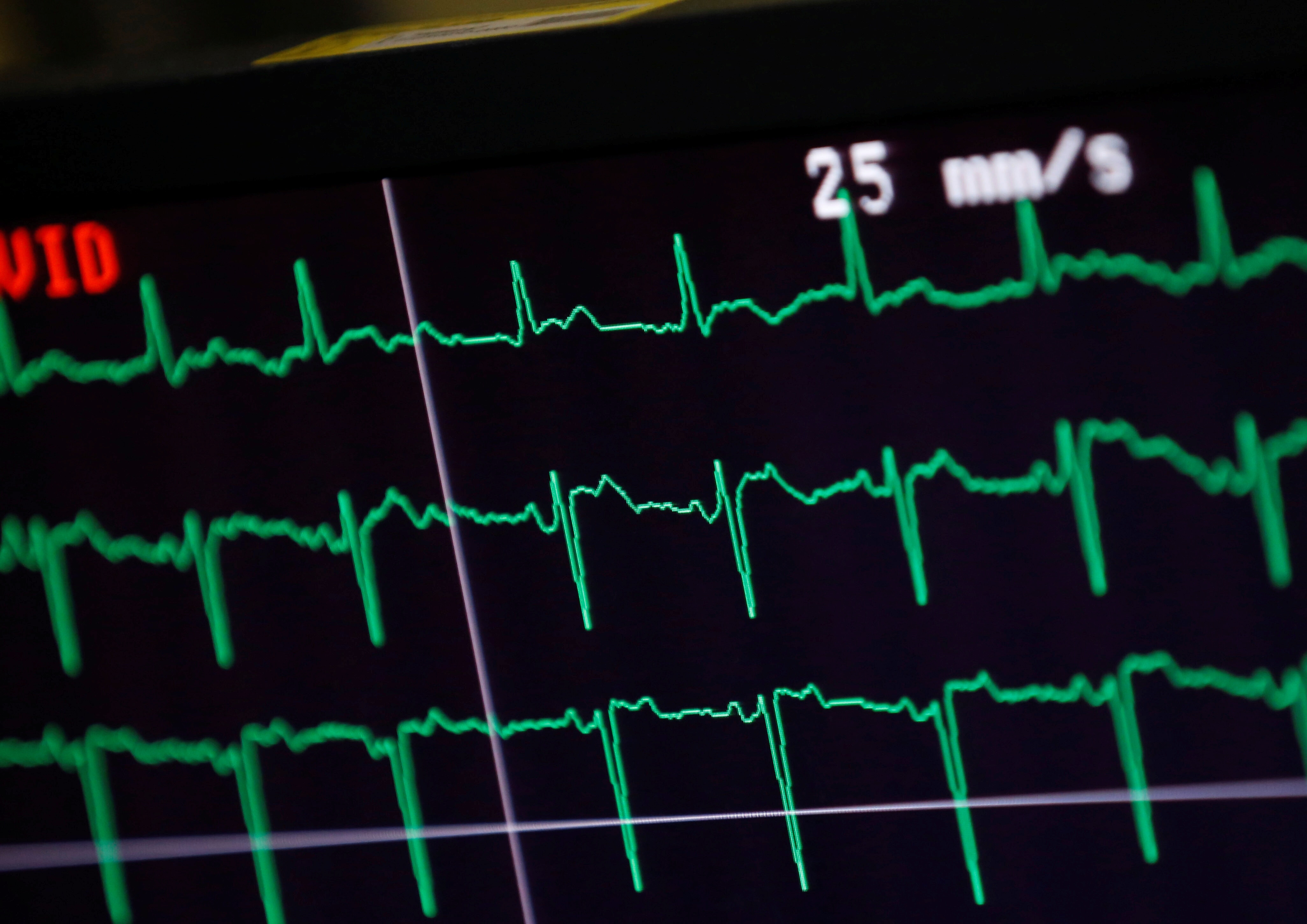 A control monitor is seen during a heart catheterization at the Heidelberg University Hospital (Universitaetsklinikum Heidelberg) in Heidelberg, Germany, August 14, 2018. Picture taken August 14, 2018. To match Insight HEALTHCARE-MEDICAL TECHNOLOGY/AI   REUTERS/Ralph Orlowski. climate
