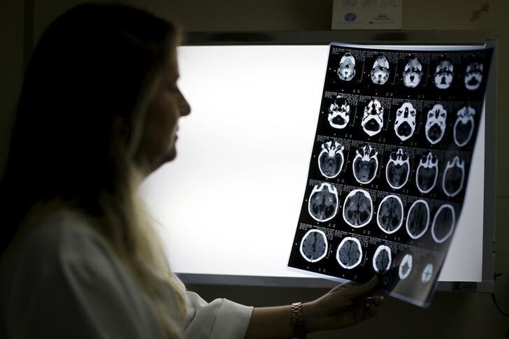 Child Neurologist Vanessa Van Der Linden observes the X-ray of a baby's skull with microcephaly at the hospital Barao de Lucena in Recife, Brazil, January 26, 2016. Health authorities in the Brazilian state at the center of a rapidly spreading Zika outbreak have been overwhelmed by the alarming surge in cases of babies born with microcephaly, a neurological disorder associated to the mosquito-borne virus. Picture taken on January 26, 2016. REUTERS/Ueslei Marcelino