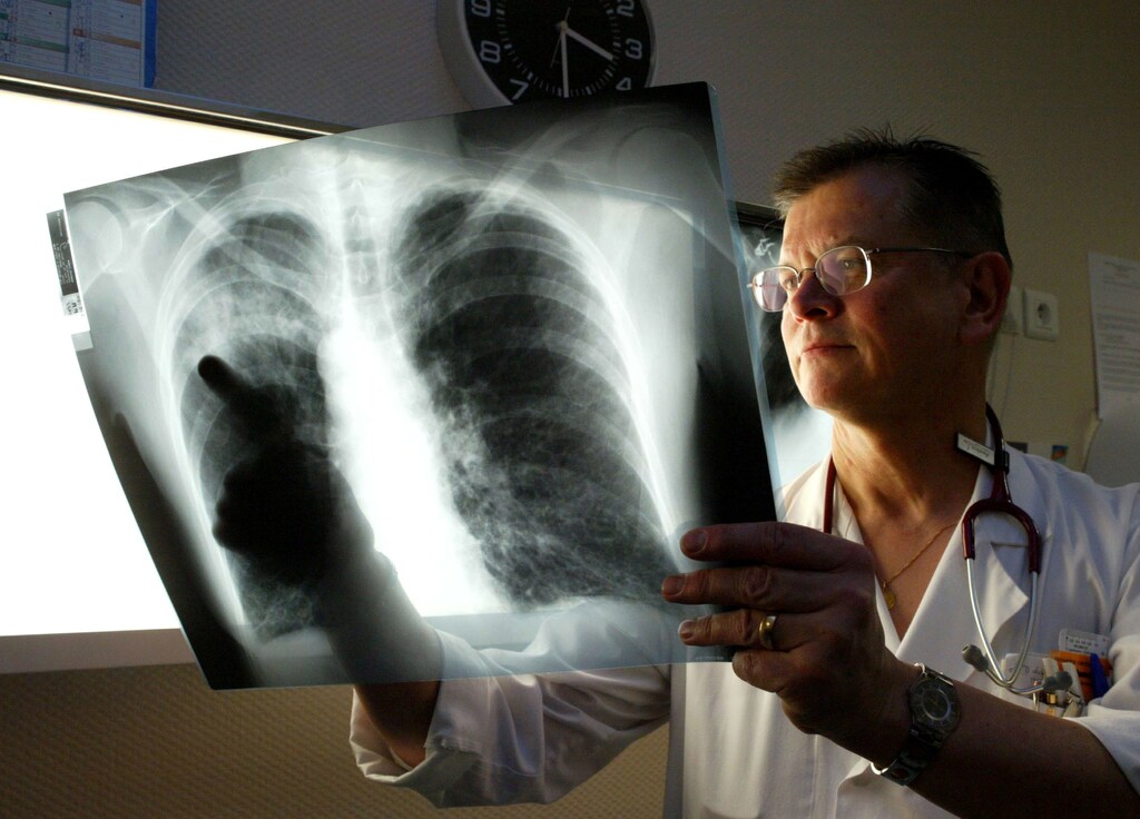French doctor Sylvestre Rutkiewicz looks at a patient's x-ray at the Henin Beaumont private hospital in northern France, January 2, 2004. Experts have been sent to northern France to investigate an outbreak of Legionnaire's disease that has left six people dead and over 50 sick since November 2003. - PBEAHUOLJDE