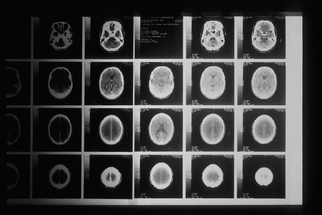 Una foto en blanco y negro de varias imágenes de resonancia magnética.