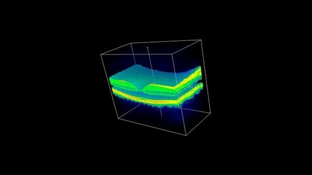 Analysing 3D images of the eye can diagnose eye diseases quicker            