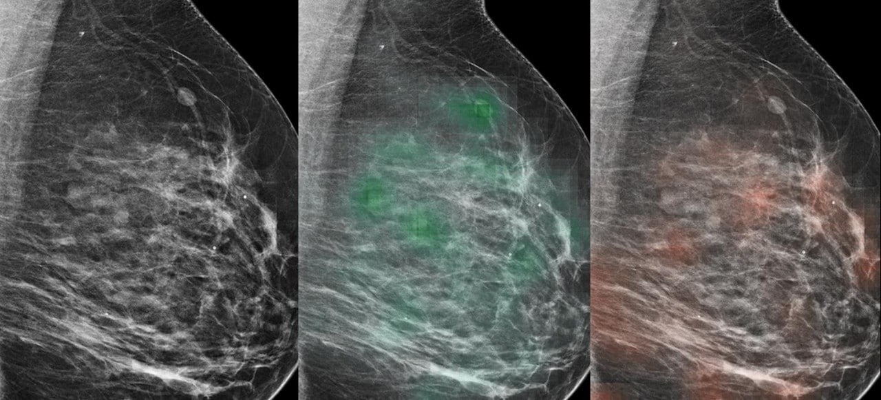 The AI tool learned to predict which lesions were likely malignant (red heat map) or likely benign (green heat map), with potential to aid radiologists in the diagnosis of breast cancer.