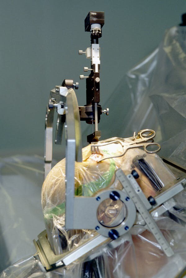 Chirurgie parkinsonienne.