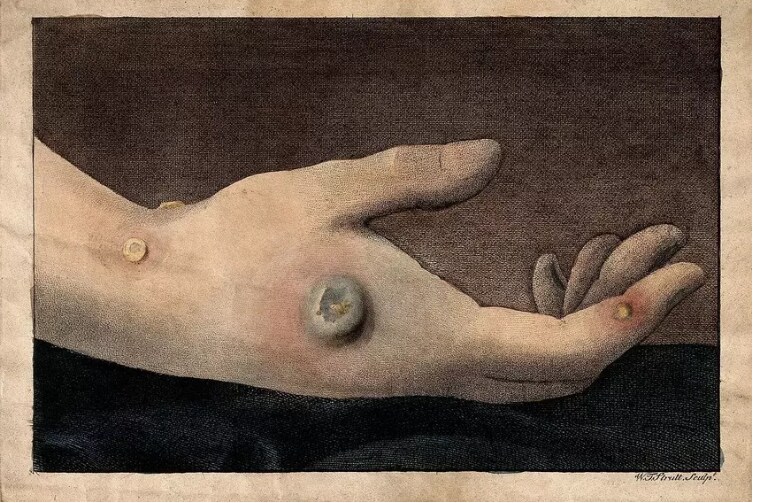 Une illustration des pustules de la smallbox