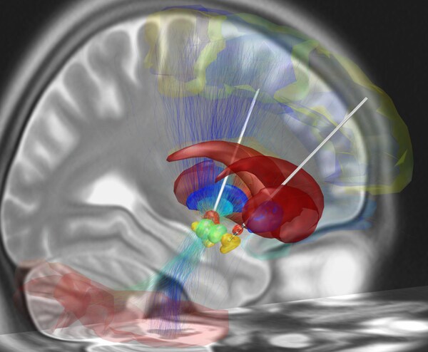 Stimulation par électrodes implantées dans le cerveau.